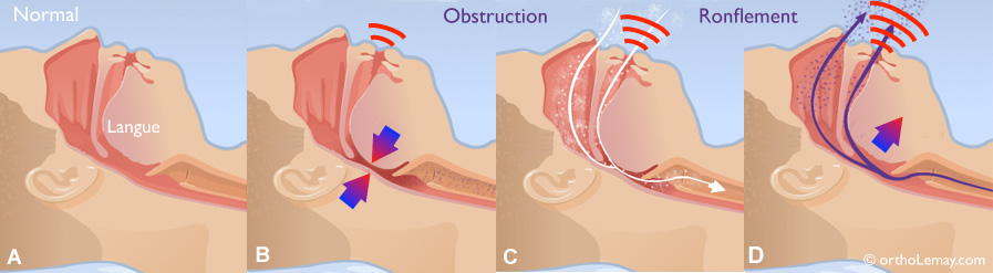Ronflement snoring obstruction voie respiratoire ortholemlay Ronflement et apnée du sommeil. Snoring and sleep apnea