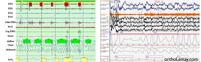 Tout savoir sur les troubles respiratoires du sommeil (TRS) - inphysiofr