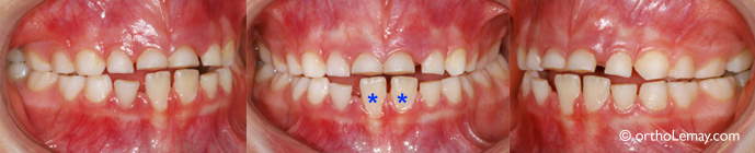 Constriction macxillaire bilatérale, grincement de dents, usure dentaire importante et ronflement chez un garçon de 6 ans